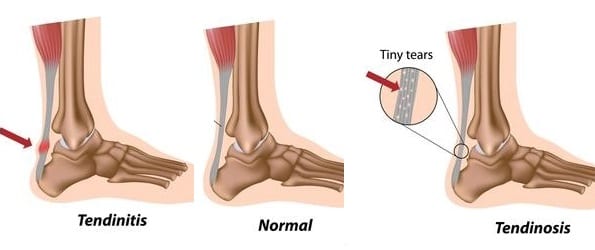 Depictions of Achilles tendinitis and tendinosis