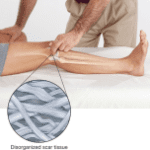 diagram of dysfunctional ligament sprain scar tissue being treated by massage therapist