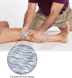 diagram of organised functional scar tissue