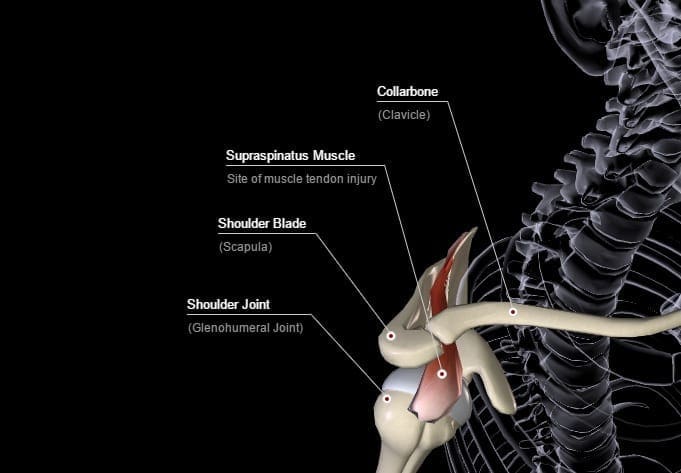 Diagram of the supraspinatus muscle showing the site of frozen shoulder injury