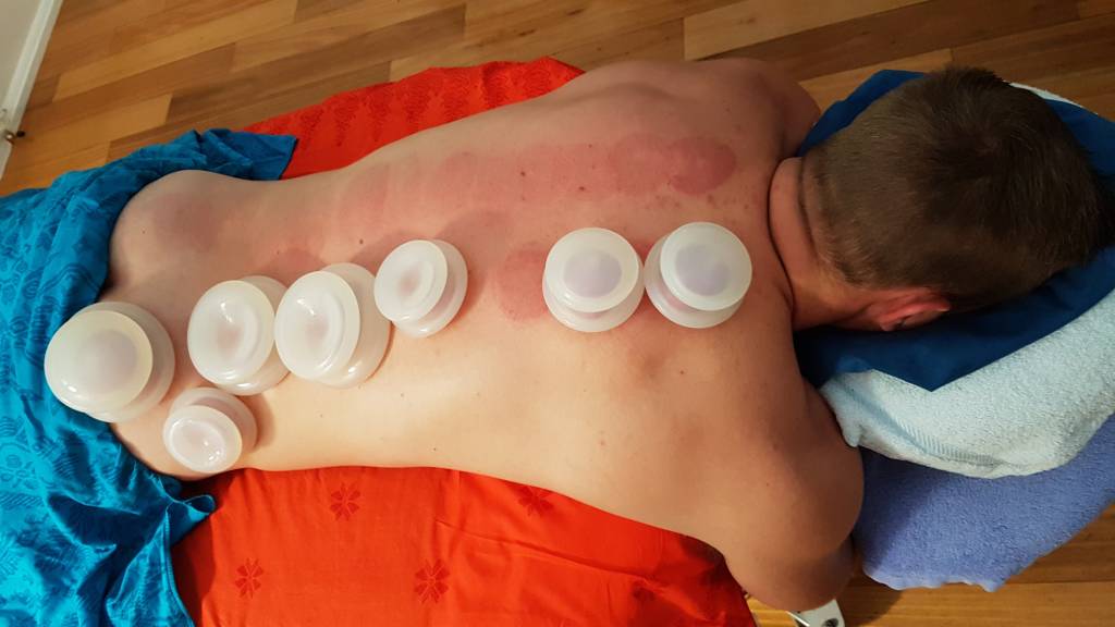 A man getting cupped on his long back muscles.